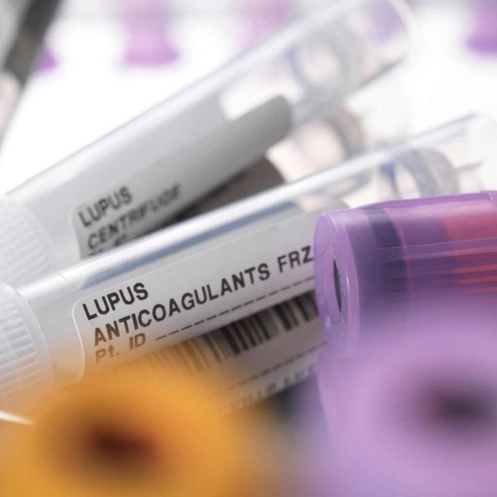 Lupus anticoagulants on a surgical tray.
