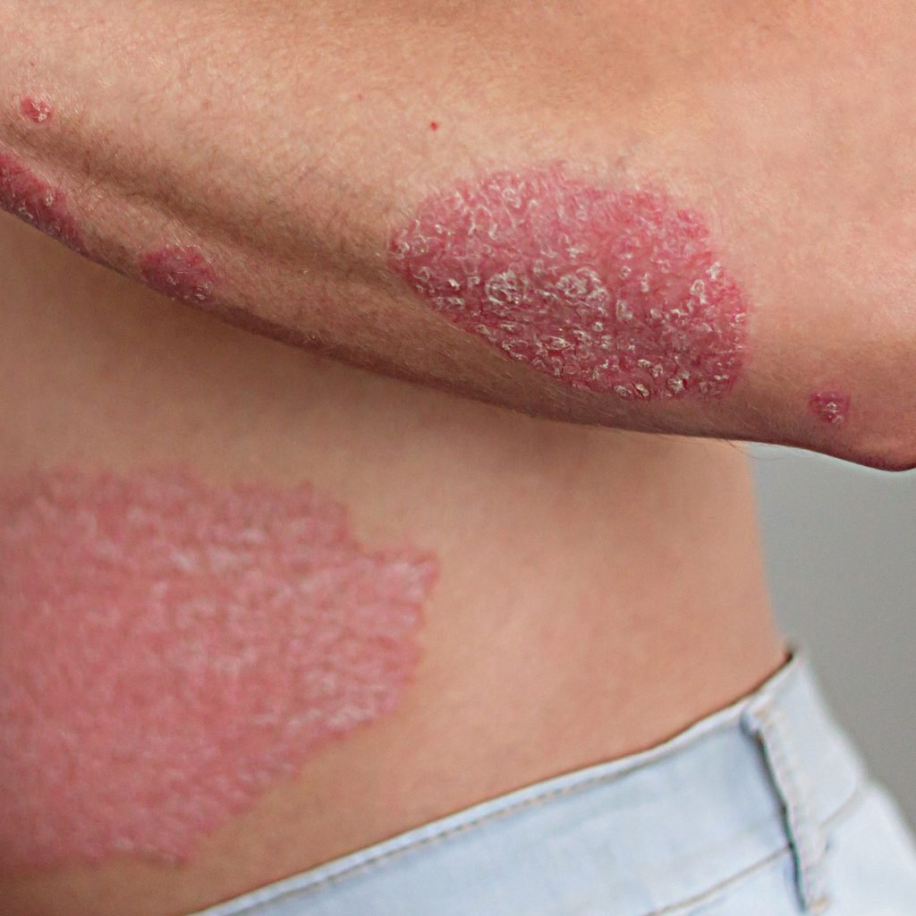 An image of a man with psoriasis on the arm and abdomen.