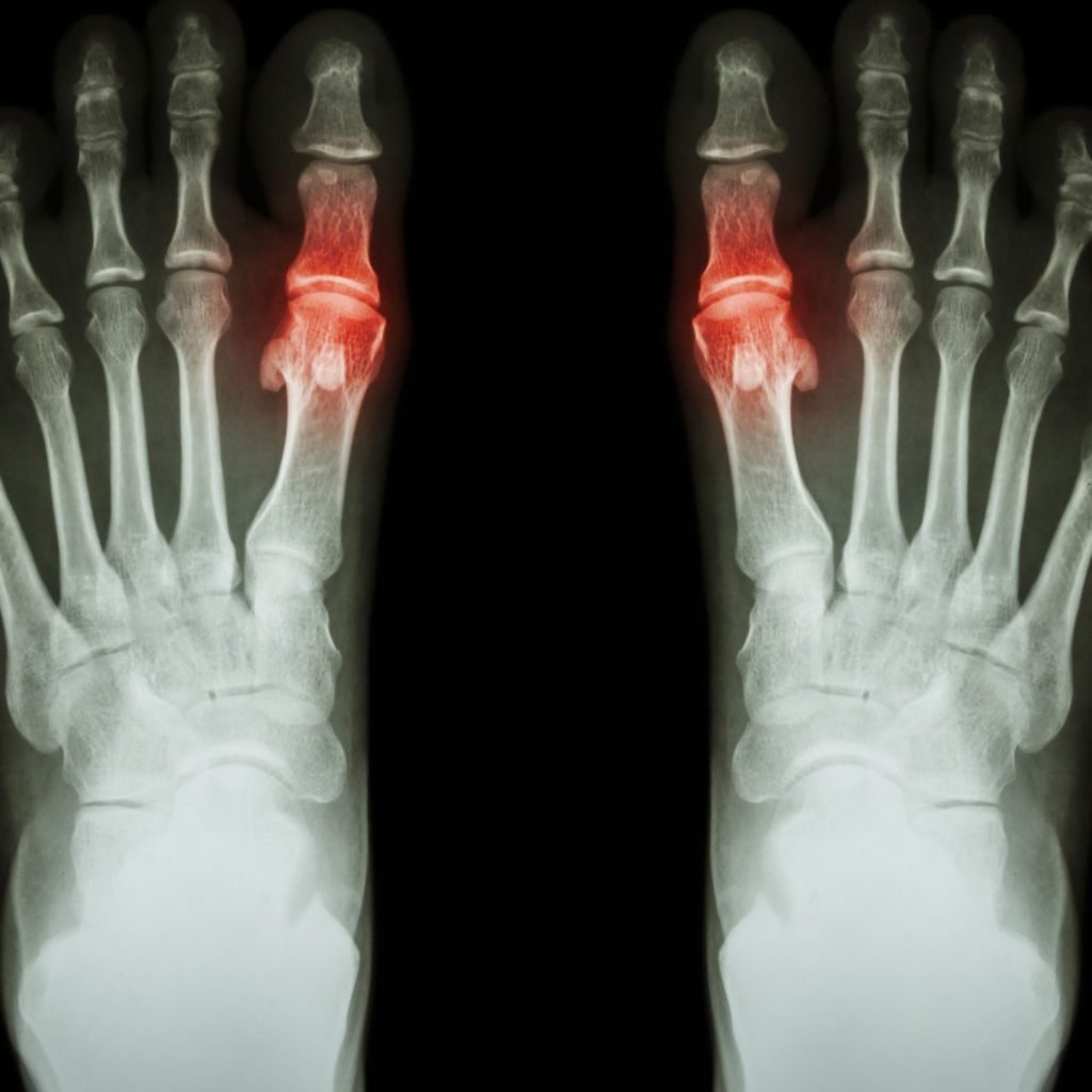 An imaging showing human hands afflicted with Rheumatoid arthritis.