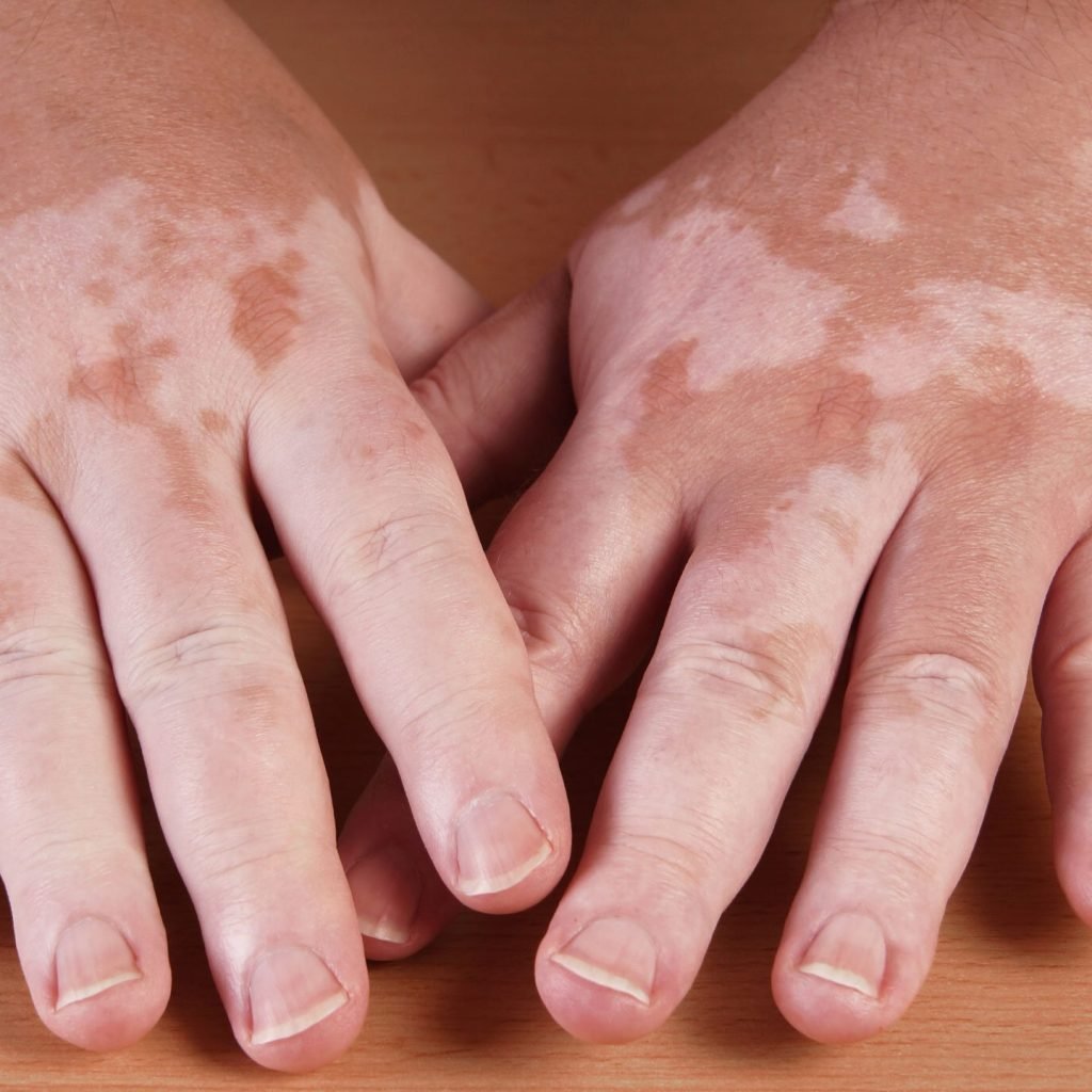 An image of human hands affected with vitiligo.