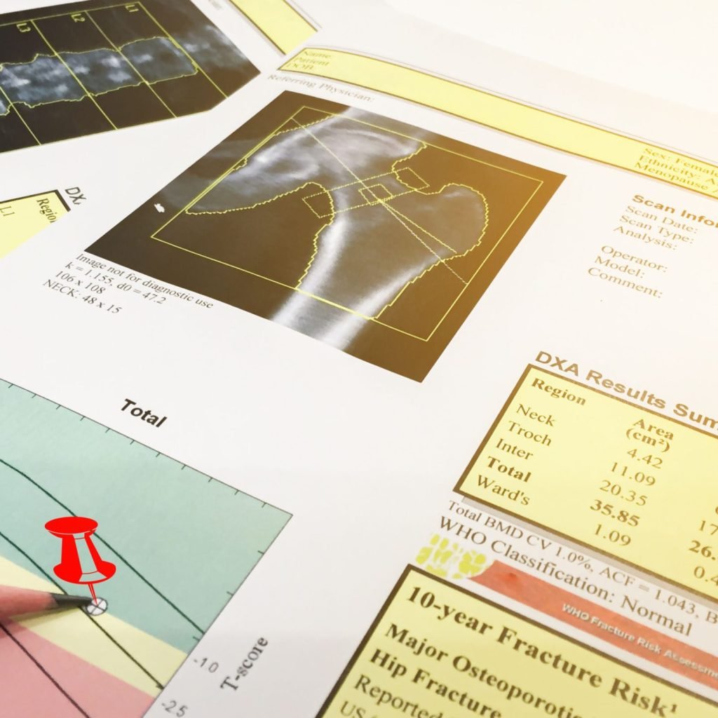 An image of the scan results for bone mineral density test.