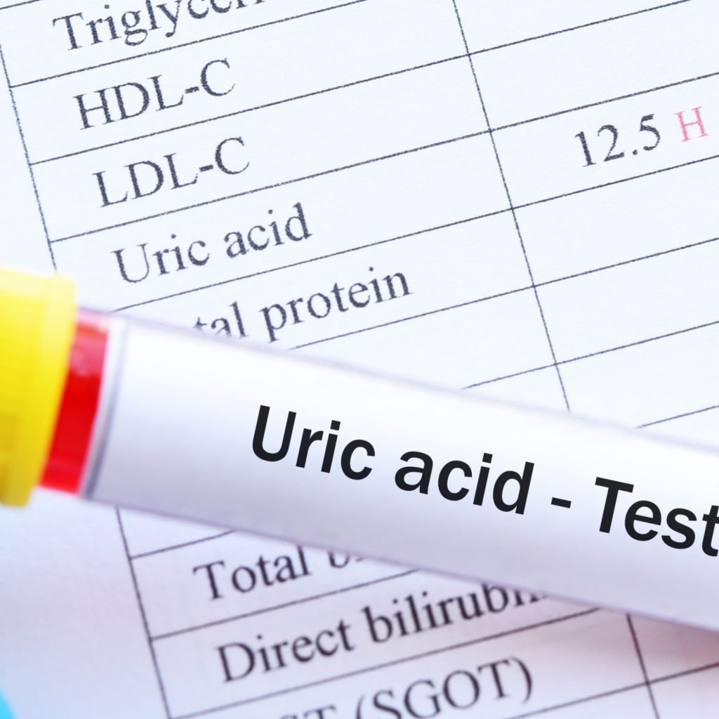 Blood sample tube with a report showing abnormally high levels of uric acid.