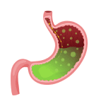 Heartburn Remedies