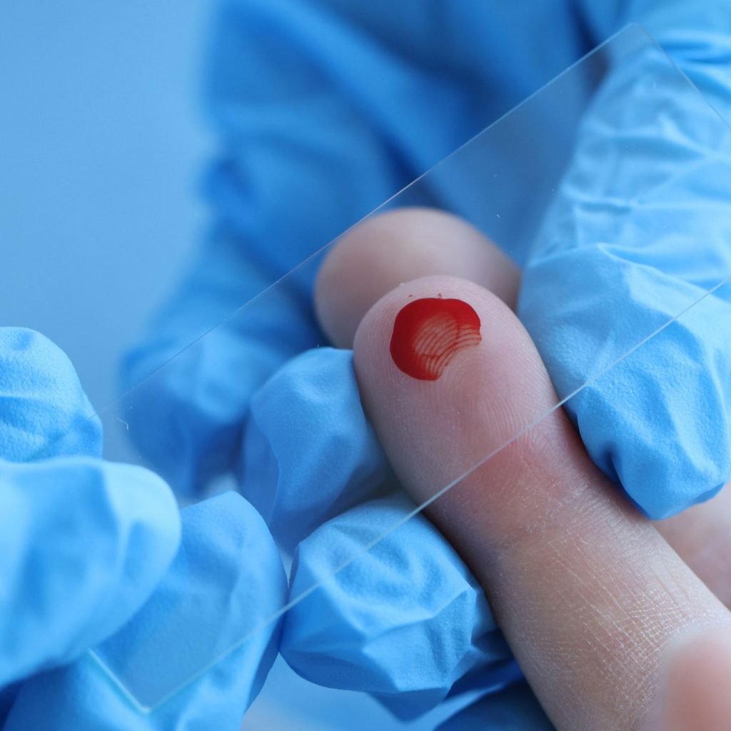A blood sample is taken to know hemoglobin levels.